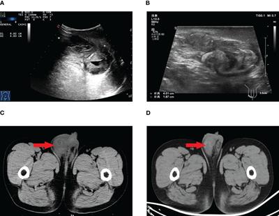 Sunitinib for adenocarcinoma of the rete testis: a case report